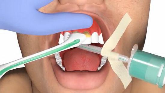 Oral hygiene. Modified Bass brushing technique